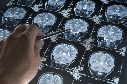 Preocupación ante la decisión de no financiación por el Sistema Nacional de Salud de lecanemab y donanemab para la enfermedad de Alzheimer